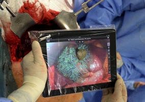 Usando un iPad para hacer un trasplante de hígado
