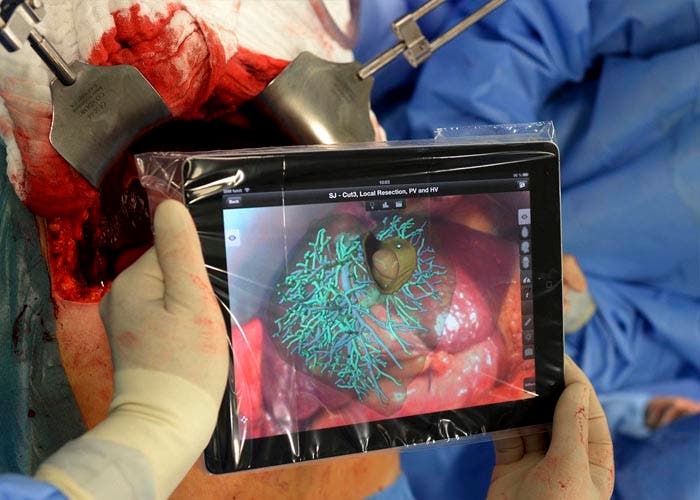 Usando un iPad para hacer un trasplante de hígado